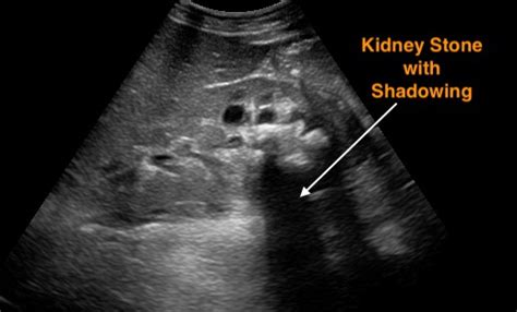 Ultrasound And Kidney Stones