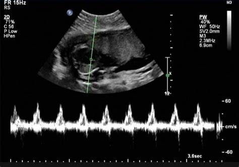 Ultrasound For Fetal Heartbeat