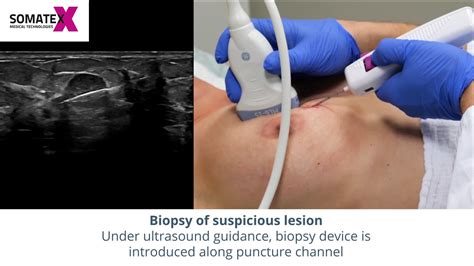Ultrasound Guided Breast Biopsy