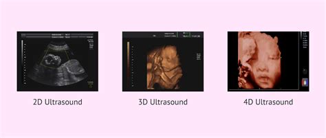 Ultrasound Image