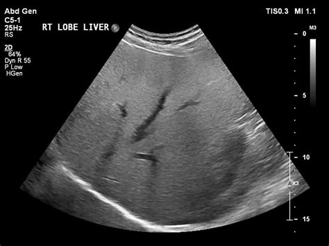 Ultrasound Of Fatty Liver Disease