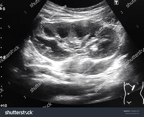 Ultrasound Of Kidney