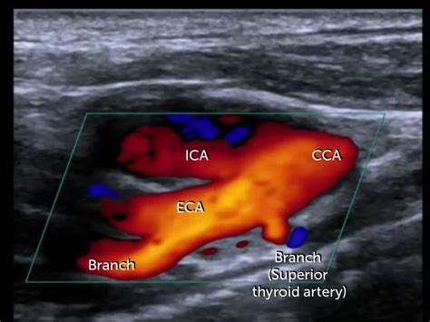 Ultrasound On Carotid Arteries