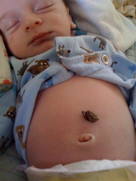 Umbilical Cord Fall Off