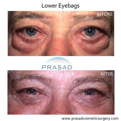 Under Eye Bag Surgery