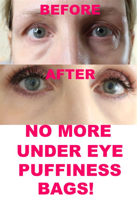 Under Eye Bags And Puffiness