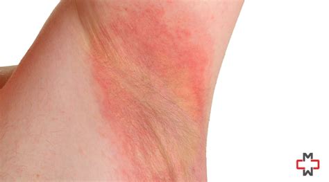 Underarm Rash Treatment