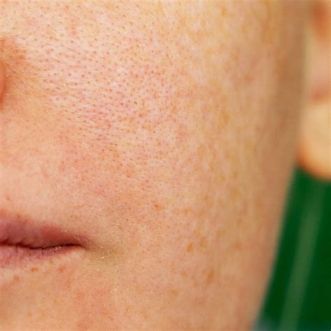 Uneven Skin Color