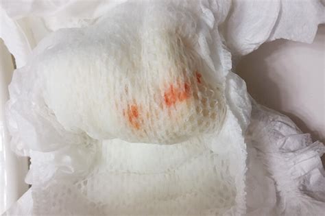 Urate Crystals In Diaper