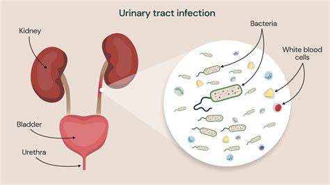 Urinary Tract Infection Backache