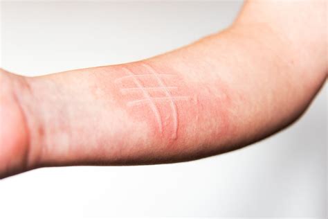 Urticaria Skin Writing