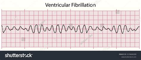 V Fib Rhythm Strip