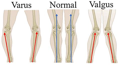 Valgus Vs Varus