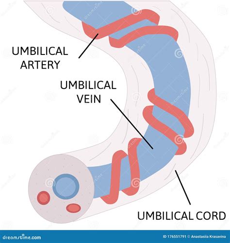 Varicose Vein Umbilical Cord