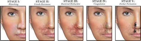 Vascular Occlusion Lip Filler