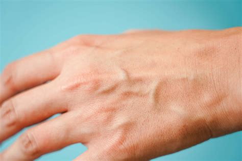 Veins Bursting In Fingers