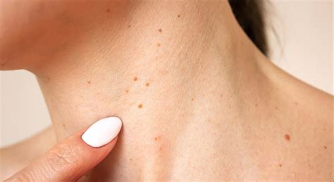 Verrugas En El Cuello