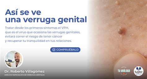 Verrugas En El Pene