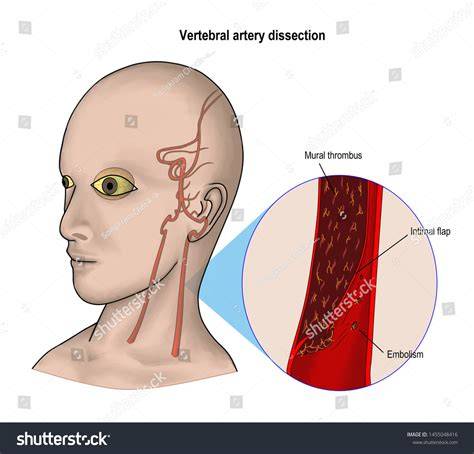 Vertebral Artery Dissection Symptoms