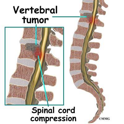 Vertebral Tumor Symptoms
