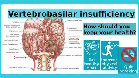 Vertebrobasilar Artery Syndrome
