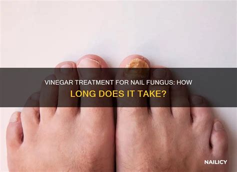 Vinegar For Nail Fungus