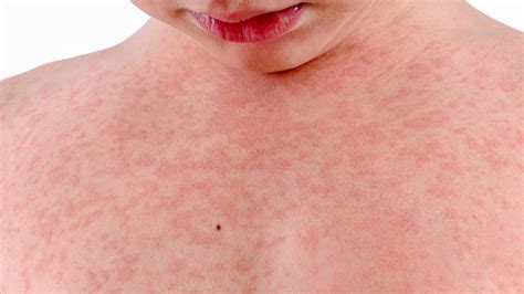 Viral Rash In Children