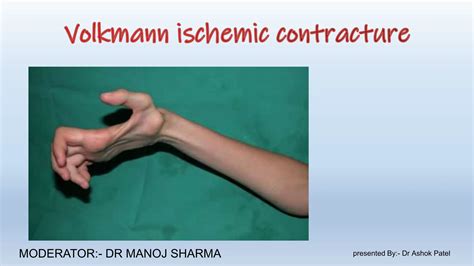 Volkmann Ischemic Contracture