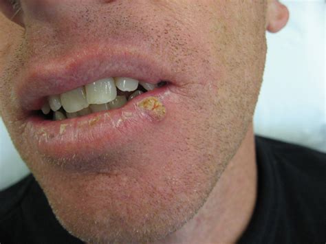 Wart On Lips