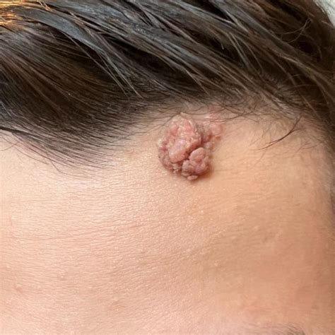 Wart Picture On Face