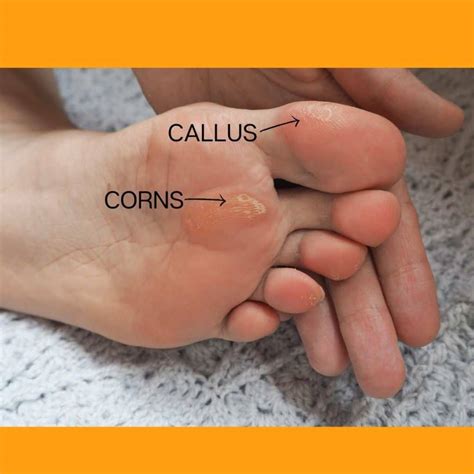 Warts Or Calluses