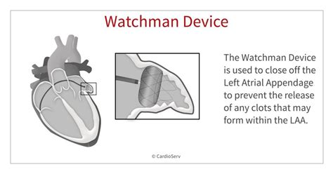 Watchman Procedure Age Limit