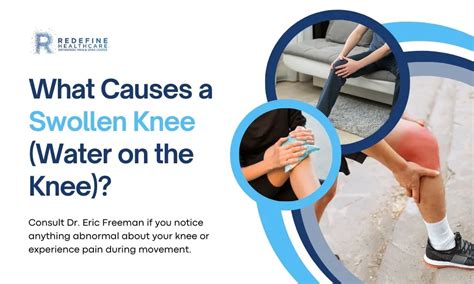 Water On The Knee