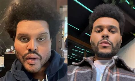 Weeknd Face Surgery