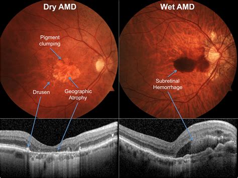 Wet Amd Symptoms