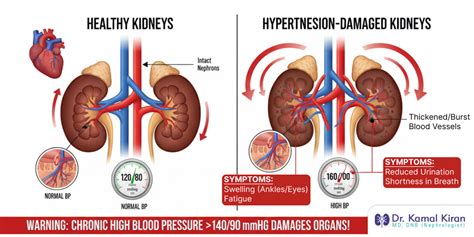 What Affects High Blood Pressure