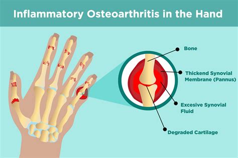 What Affects Osteoarthritis