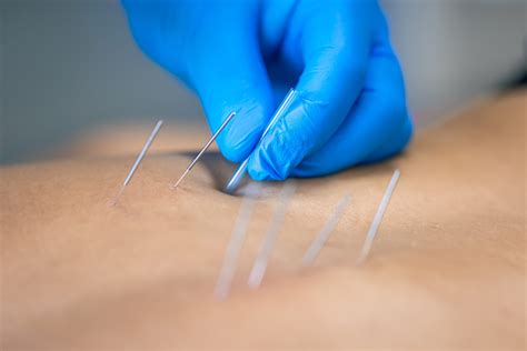 What Are Dry Needles