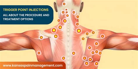 What Are Trigger Point Injections