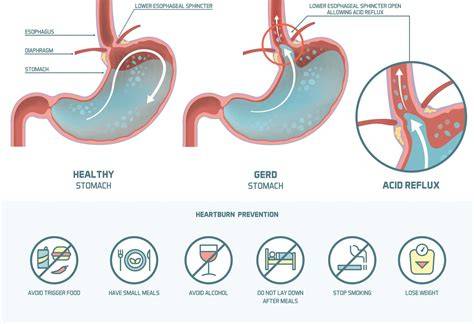 What Causes Acid Reflux