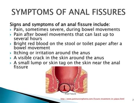 What Causes Anal Fissures