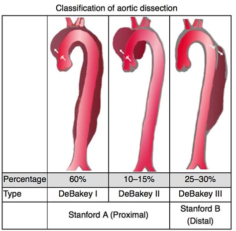 What Causes Aortic Dissection