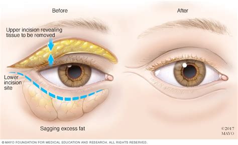 What Causes Bags Under Eyes