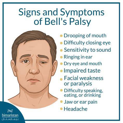 What Causes Bell's Palsy