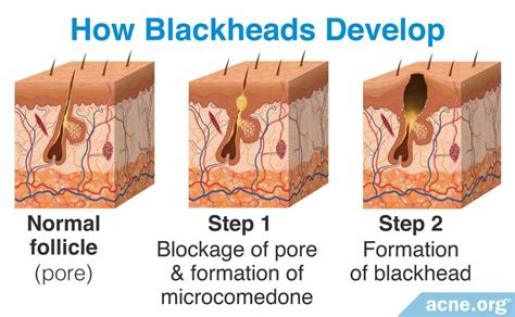 What Causes Blackheads