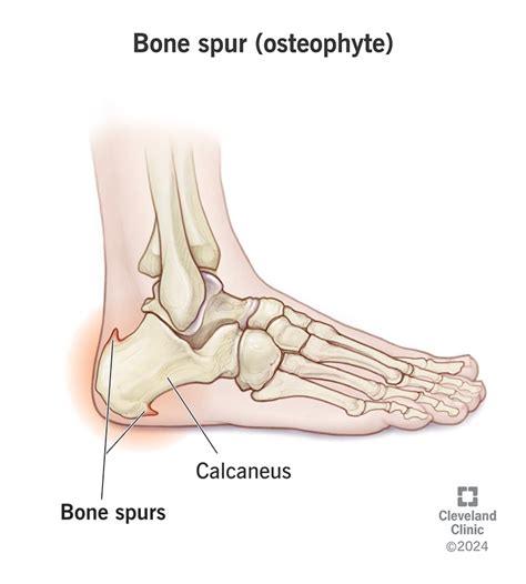 What Causes Bone Spurs