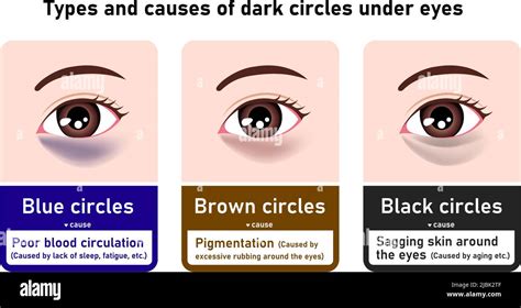 What Causes Dark Circles Under Eyes