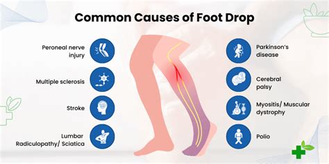 What Causes Drop Foot