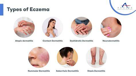 What Causes Eczema In Adults