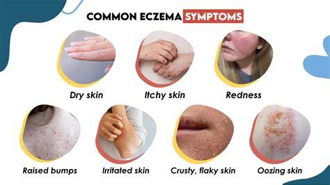 What Causes Eczema